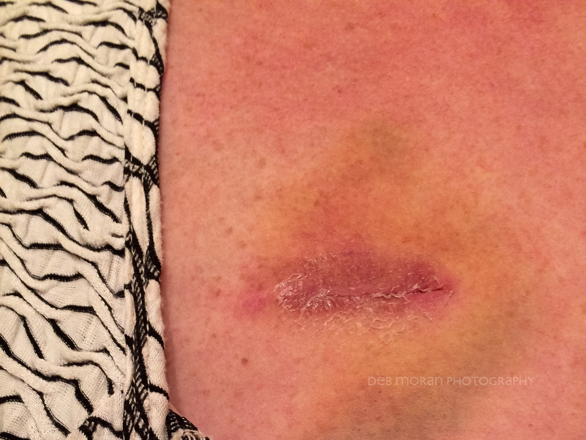 My deportation incision is healing quite well. A bit of bruising, glue sloughing off. Looks as well as I could expect.