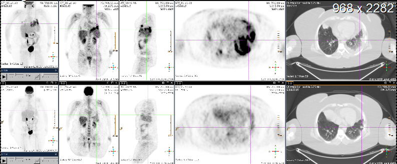 CANCER FREE(ish?) – August 24, 2015